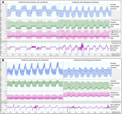 Lung aeration reduces blood pressure surges caused by umbilical cord milking in preterm lambs